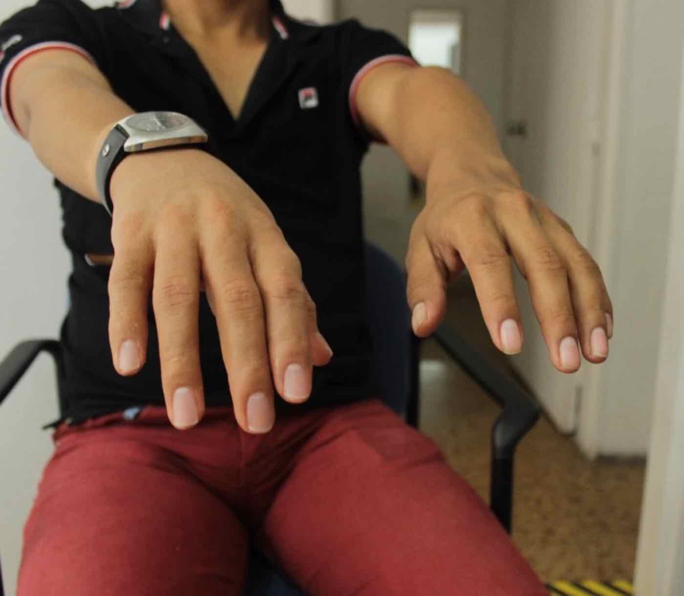 Prótesis de mano con el tono de piel igualado